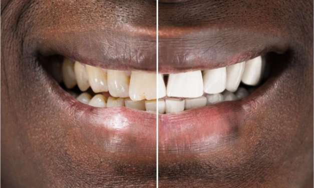 How You Can Whiten Your Teeth at Home