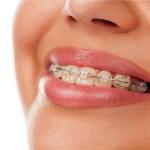 Do Fashion Braces Work?