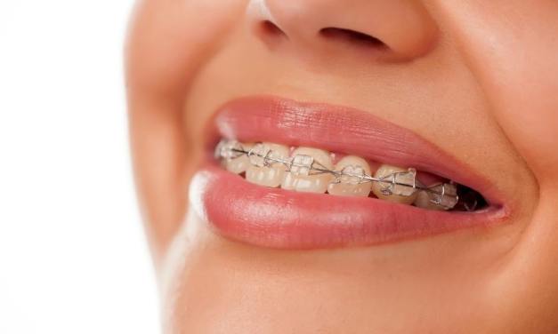 Do Fashion Braces Work?