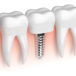 What Are Mini Implants?