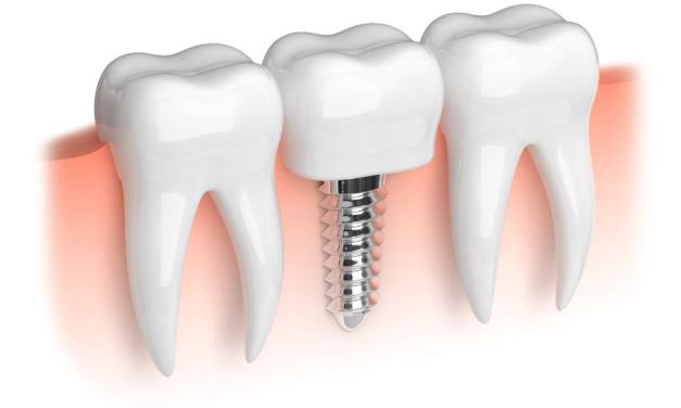 What Are Mini Implants?